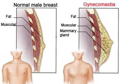 gynecomastia abroad